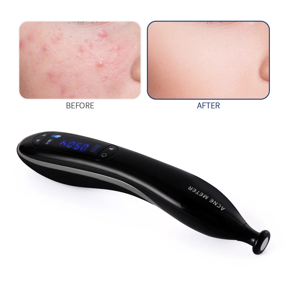 Blue Light Ozone Acne Treatment Machine Cold Plasma Skin Rejuvenation Plasma Pen for Acne Scar Wrinkle Removal jato de plasma