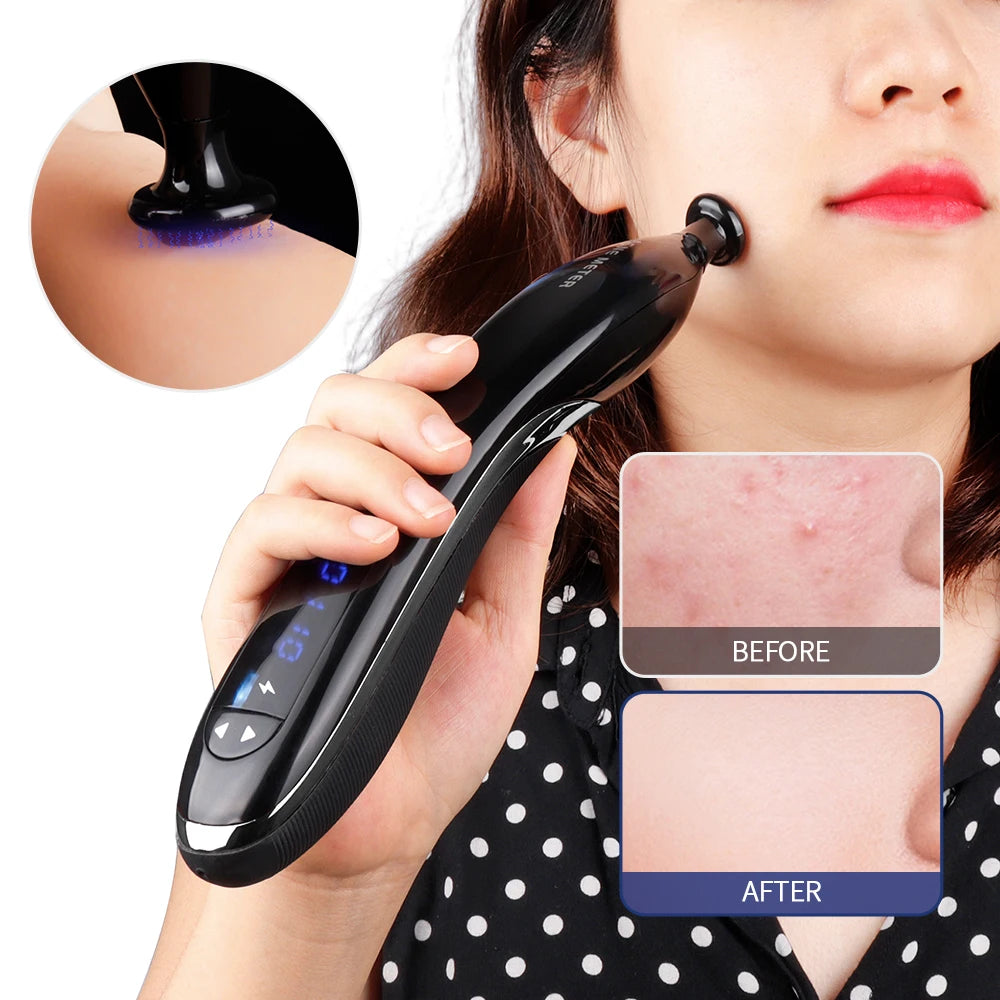 Blue Light Ozone Acne Treatment Machine Cold Plasma Skin Rejuvenation Plasma Pen for Acne Scar Wrinkle Removal jato de plasma